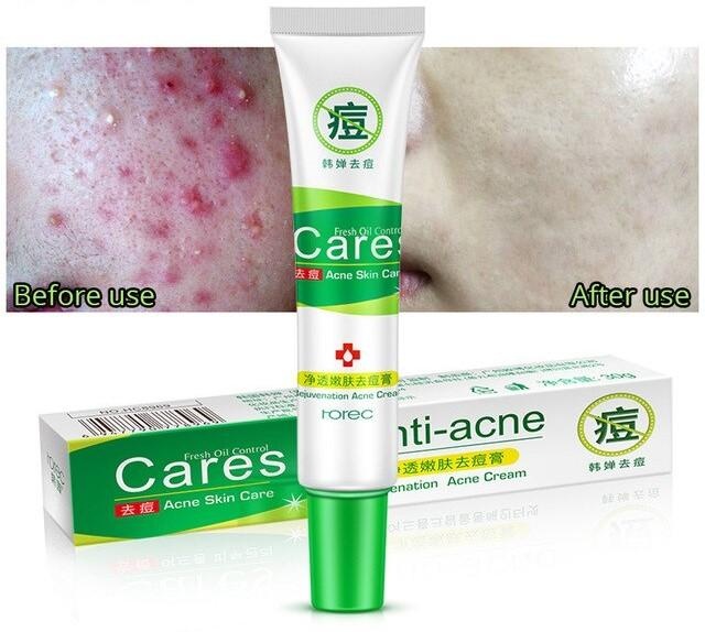 Крем от акне Rorec Cares Anti-acne с маслом Ши, 30 г